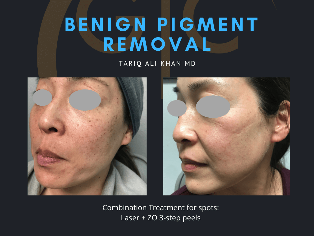 Gentle Care Laser Tustin & Long Beach Before and After picture - Mole Removal